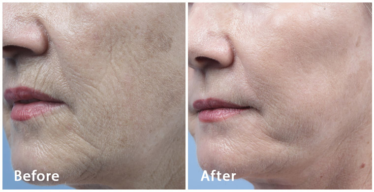 Fractora - MicroNeedling -