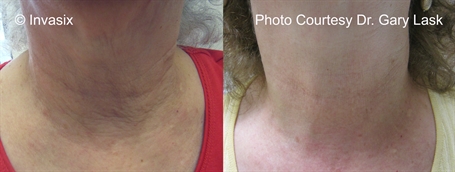 Fractora - MicroNeedling -