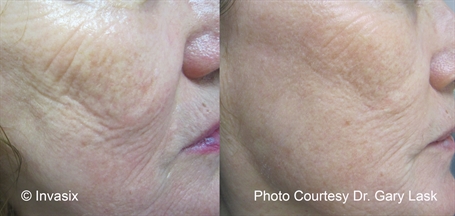 Fractora - MicroNeedling -