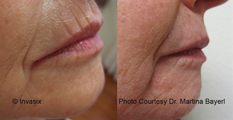 Fractora - MicroNeedling -