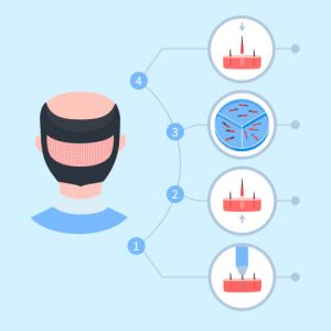 Greffe de cheveux FUE