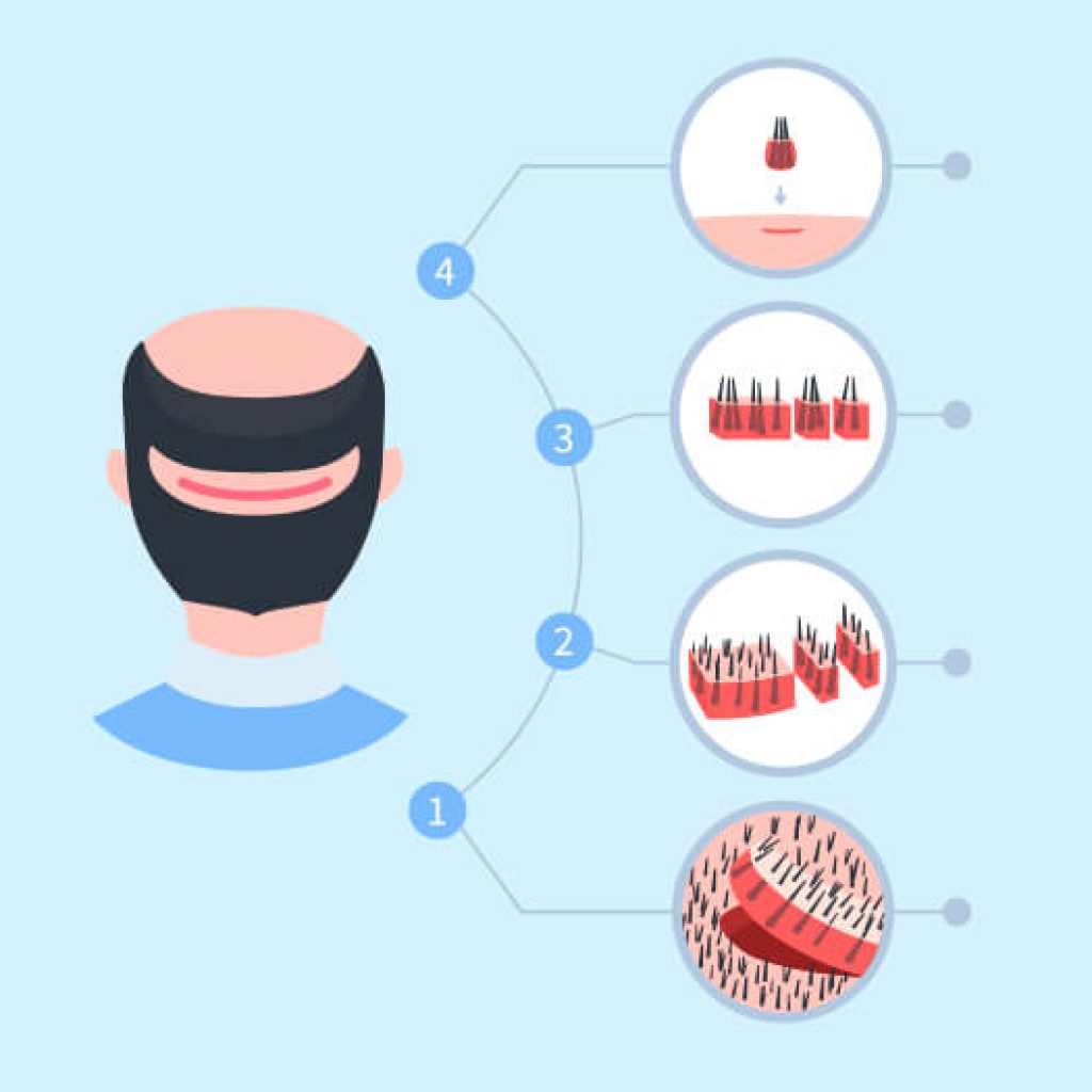 Greffe de cheveux FUT