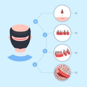 Greffe de cheveux FUT