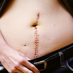 réduction des cicatrices