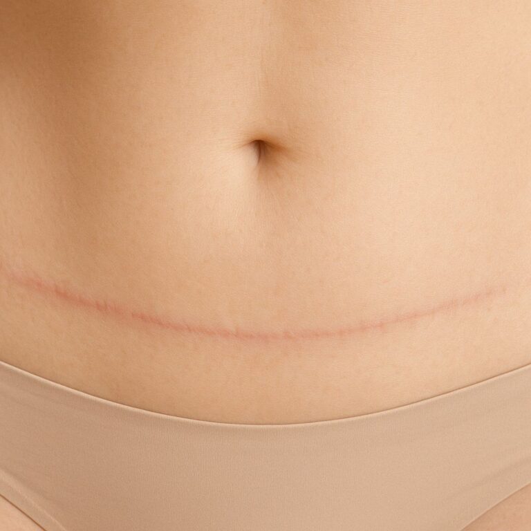 cicatrices chirurgie esthétique